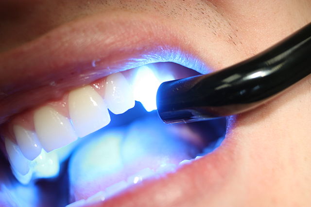 歯のコンポジットレジン修復 | 3D計測・3D測定